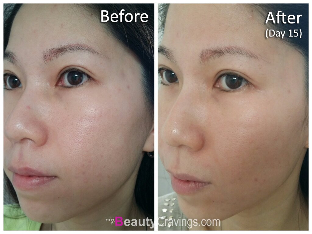 Before & After (Day 15) - VI Precision Peel