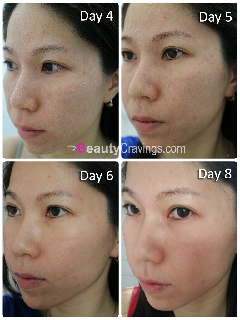 Day 4 to 8 (VI Precision Peel)