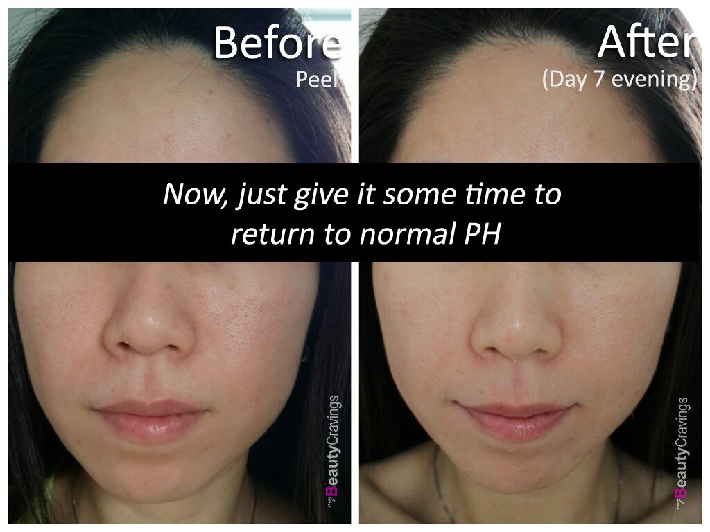 Day 7 (VI Precision Peel)