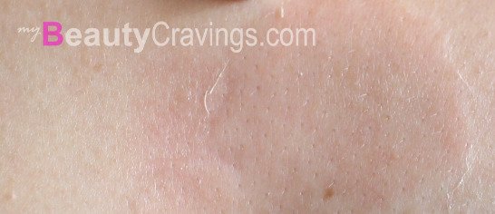 Chest peels (VI Precision Peel) 