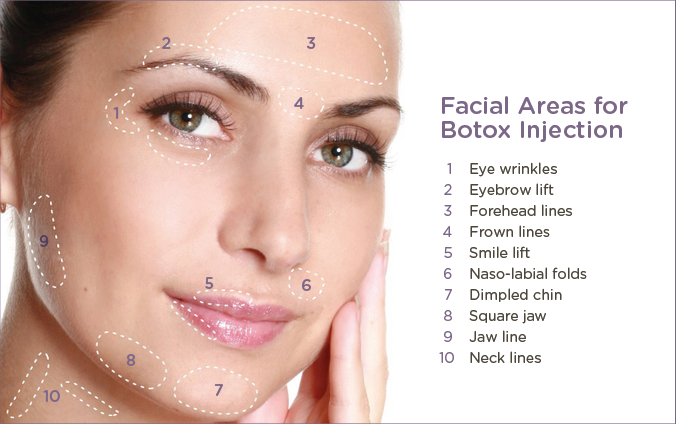 Botox pricing by areas