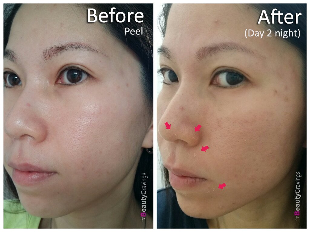 Day 2 - Night (VI Precision Peel)