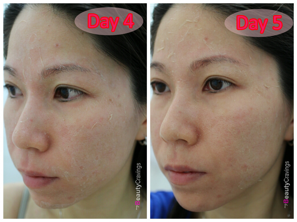 Day 4 vs Day 5 (VI Precision Peel)