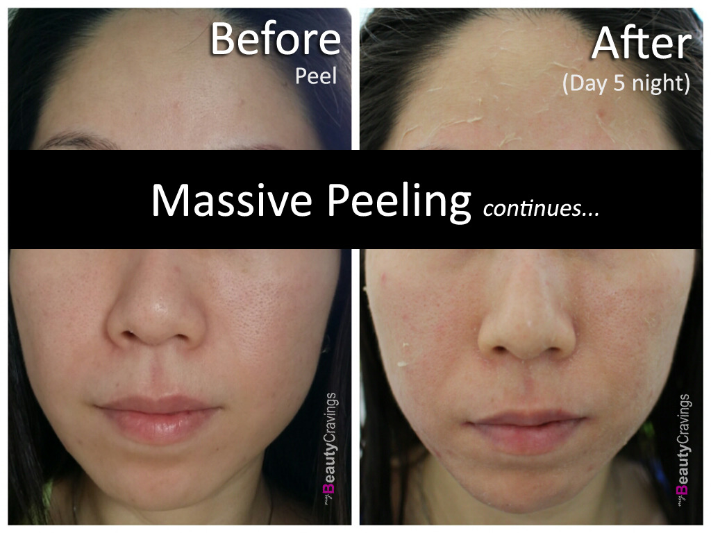 Day 5 Night (VI Precision Peel)