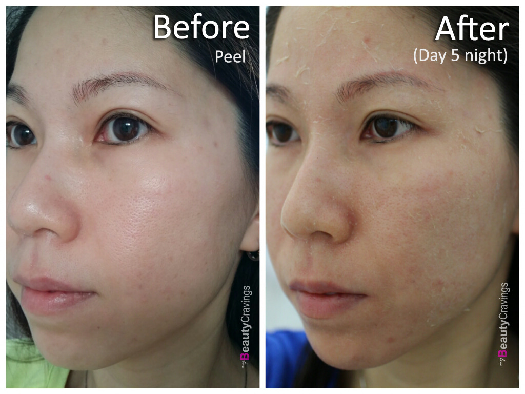 Day 5 Night (VI Precision Peel)