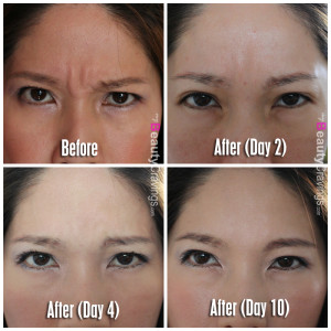 Botox Before & After: How many units needed in 30s and 40s ...