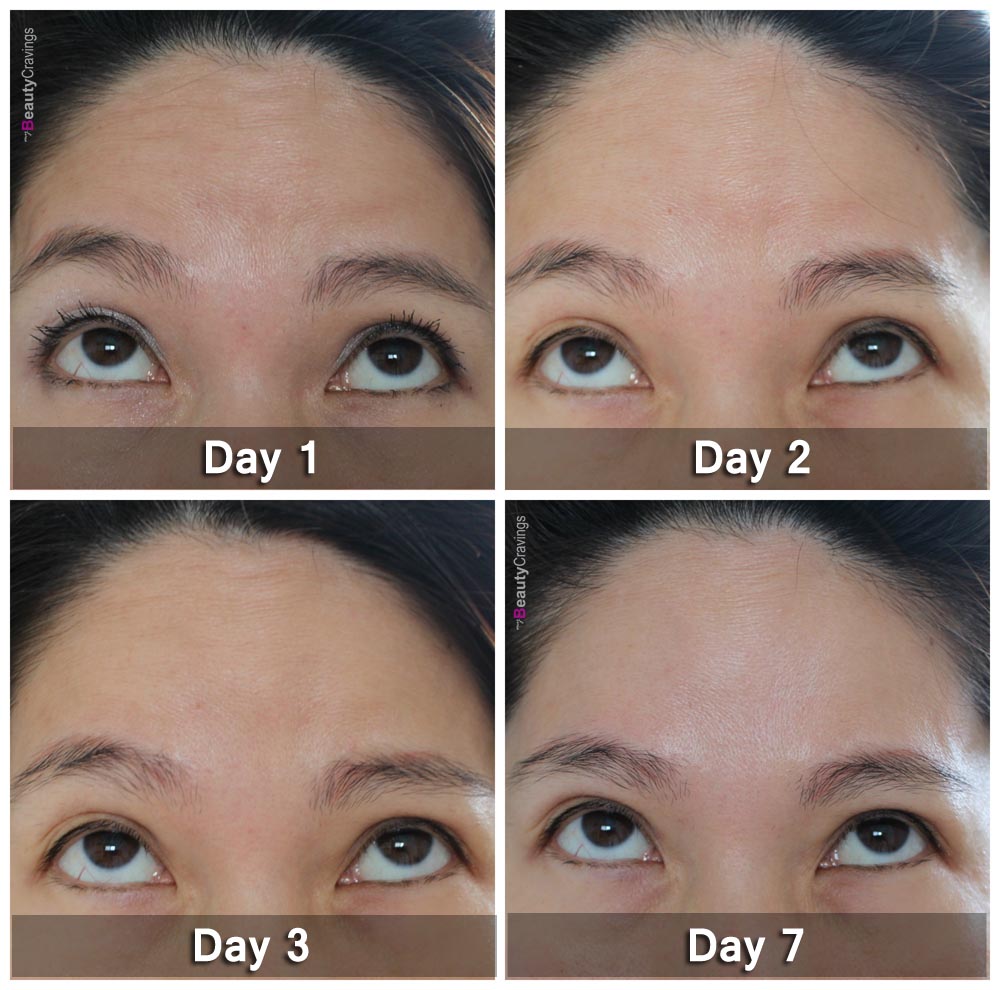 Review of Xeomin Botox Treatment at Dr Yvonne Goh Aesthetics ...