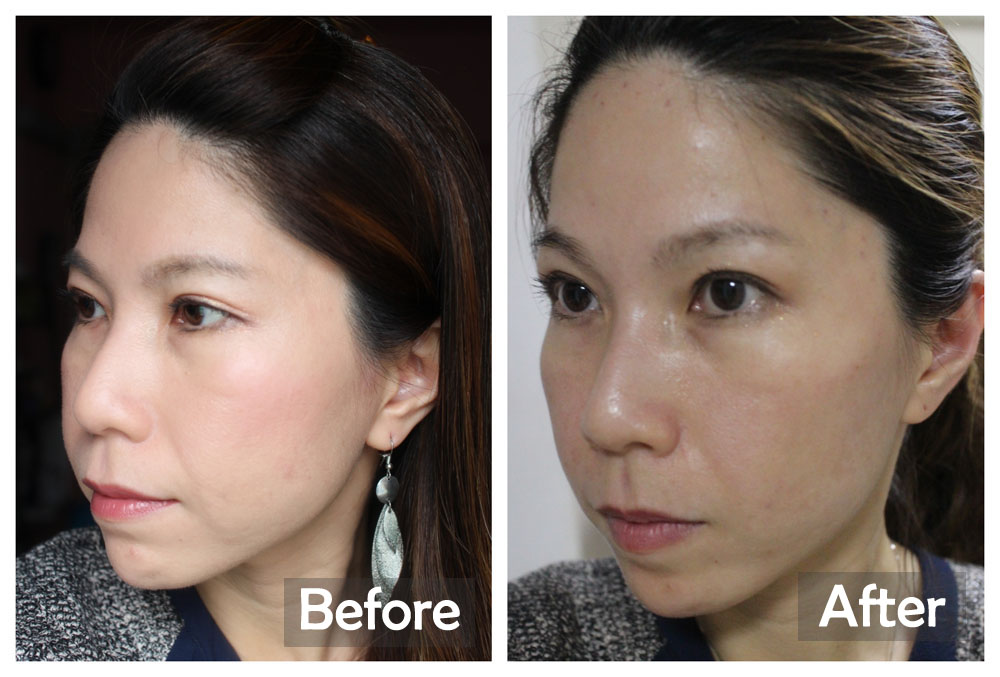 Before-After on Day 1 (Astute Medical Aesthetics)