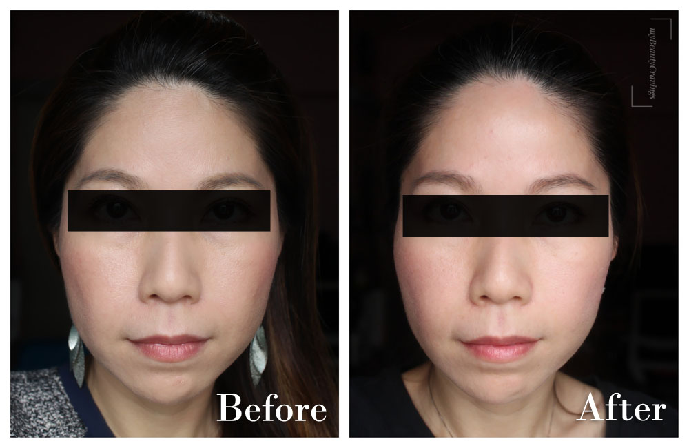 Before-After (Front Smile) - Astute Medical Centre Facial Harmony Program