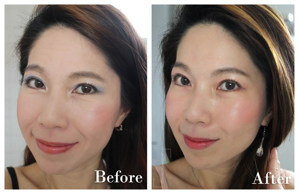 Before-After (Front Smile) - Astute Medical Centre Facial Harmony Program