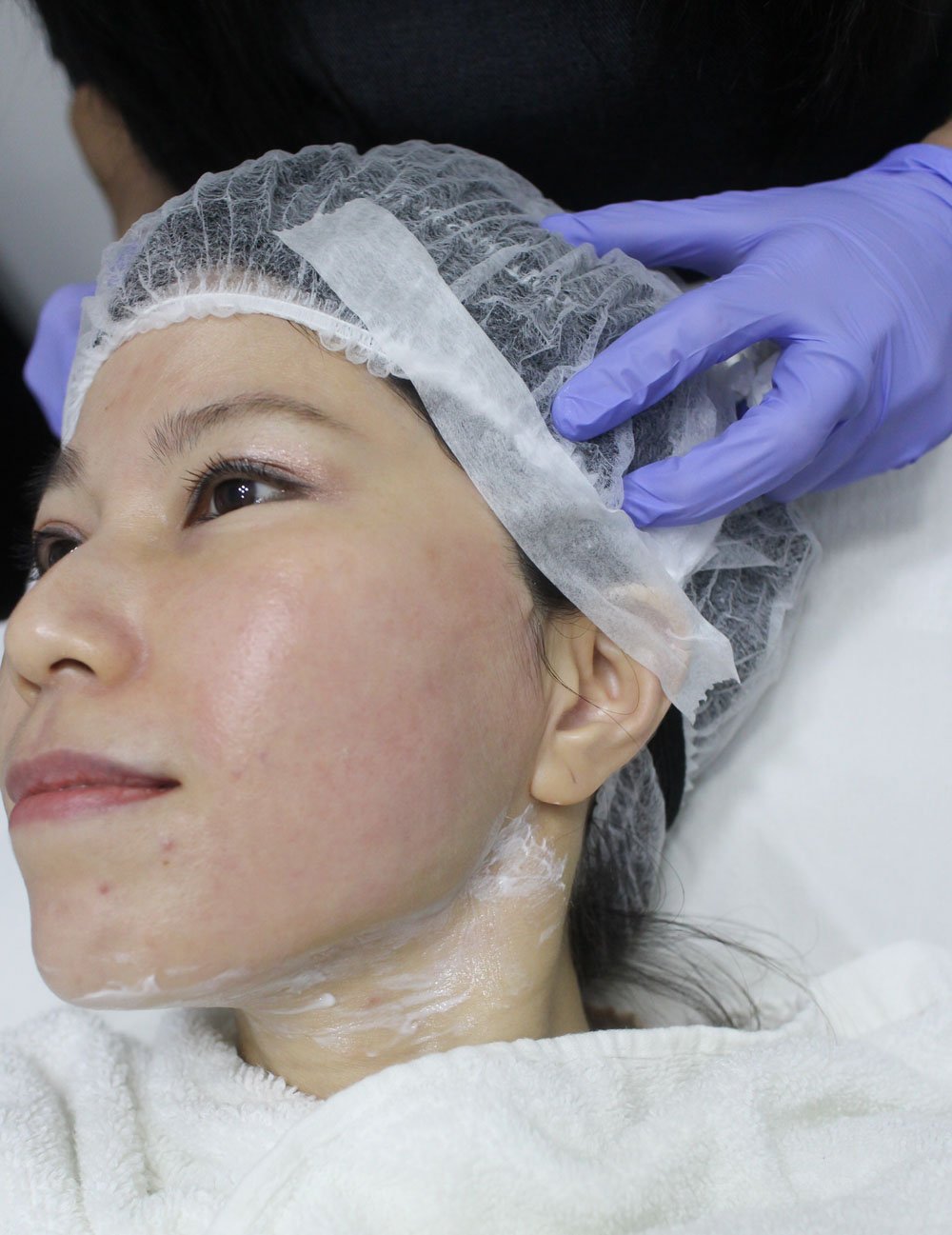 Ultherapy Singapore Face lift