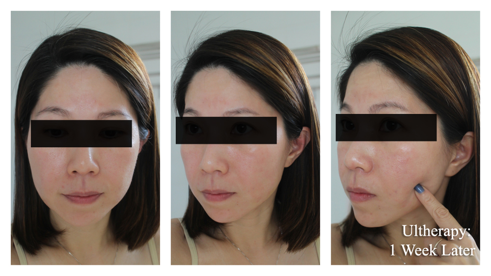 Ultherapy Before After 1 Week