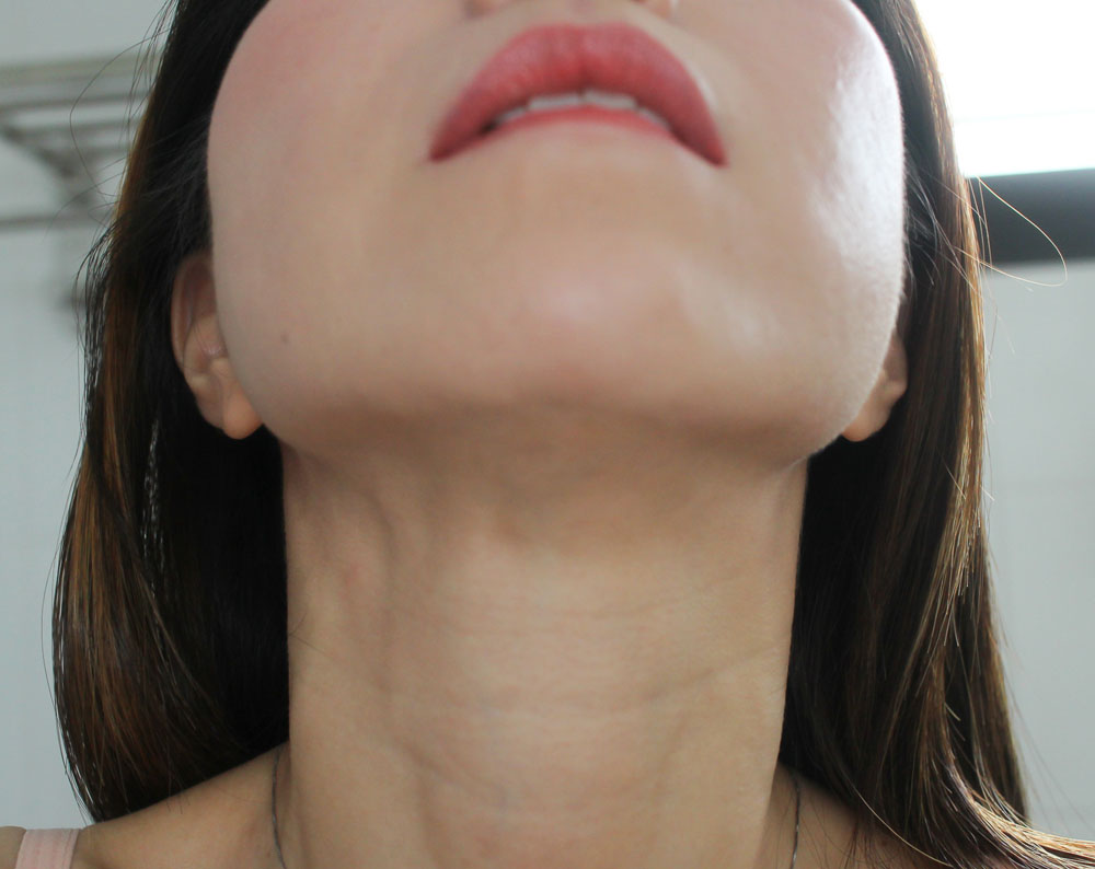 Tightening of Underchin