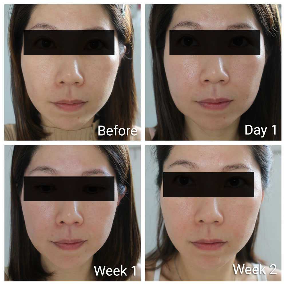 Ultherapy Results Before After Photos Show Slimmer Face And Sharper