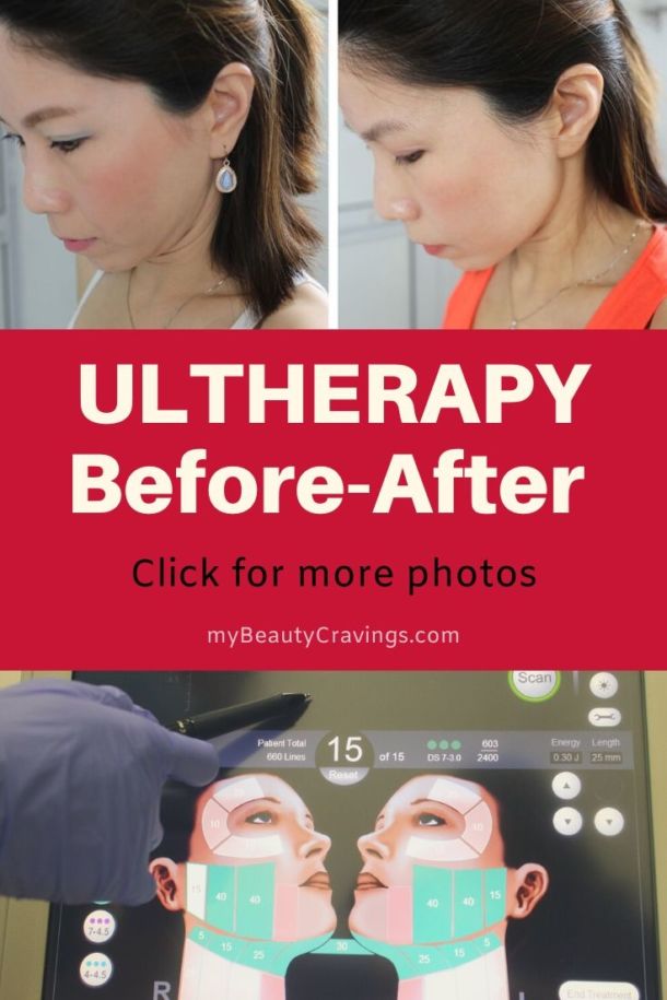Ultherapy Results Before After Photos Show Slimmer Face And Sharper