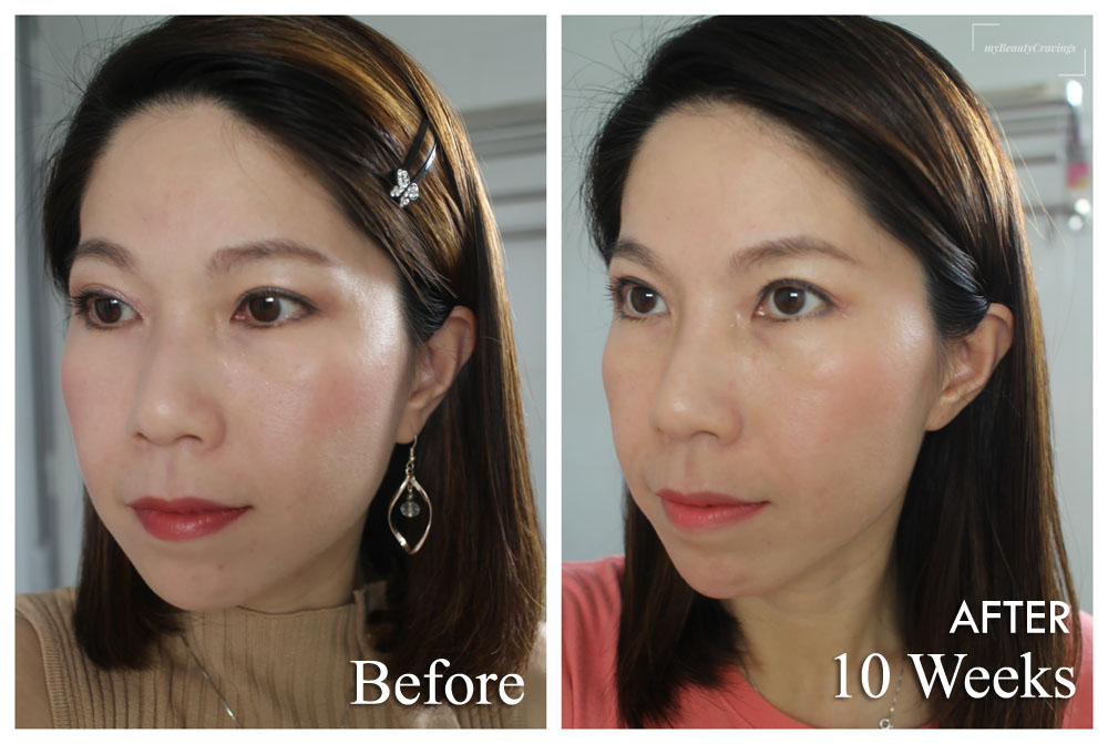 Ultherapy Results: Before & After Photos show slimmer face and sharper ...