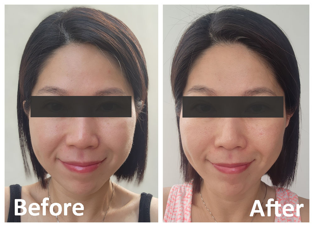 Secret Duo Before After - Front View (Smile)