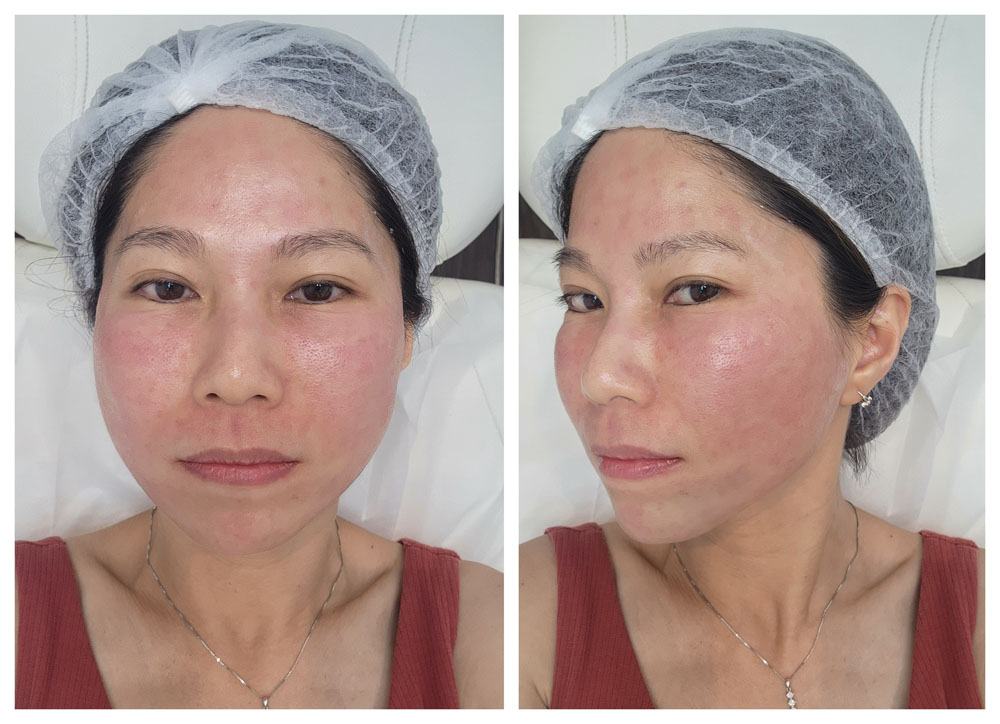 Secret Duo - Day 1 After Treatment