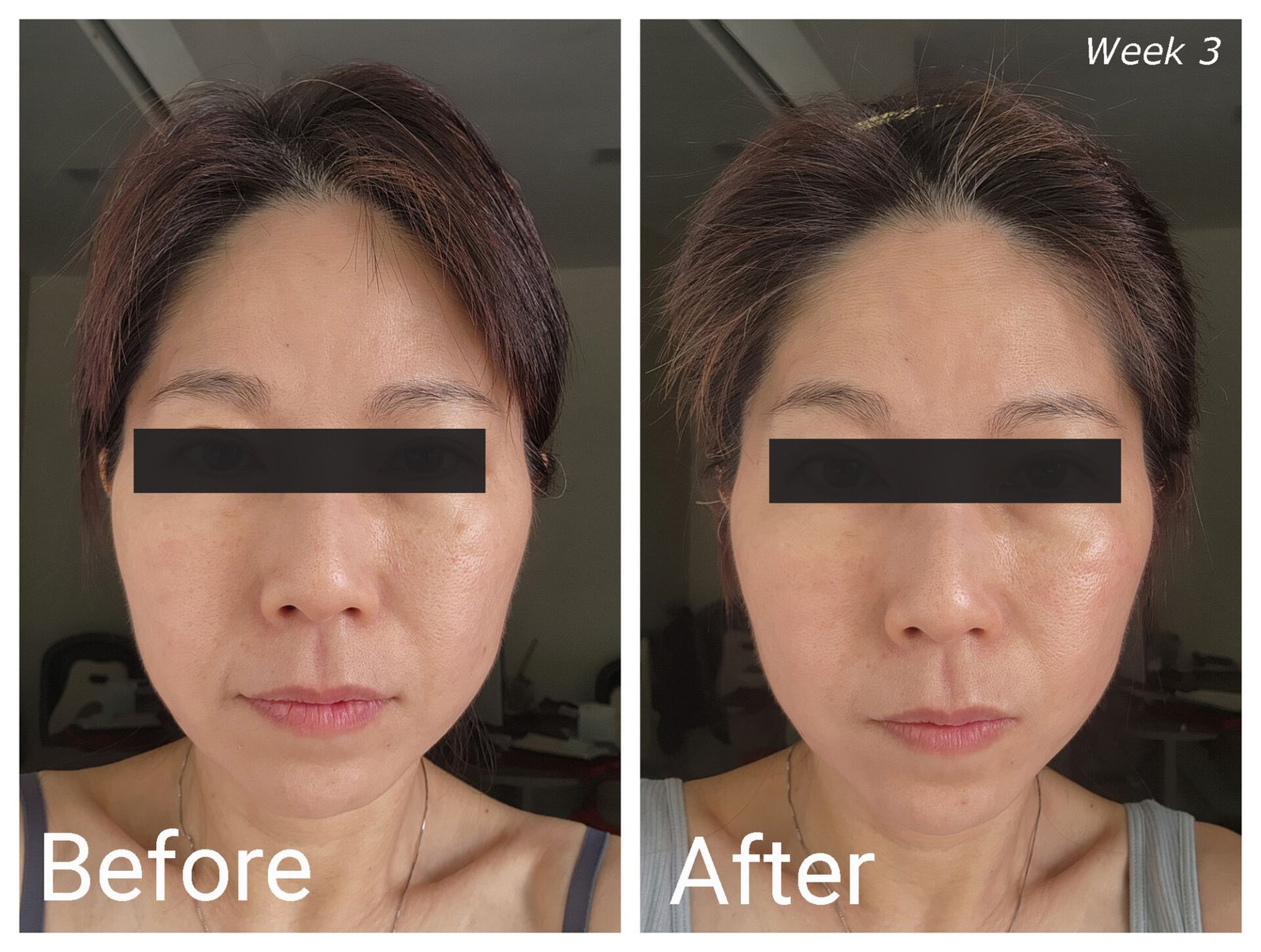 ZIIP HALO Before-After Week 3 (Front)