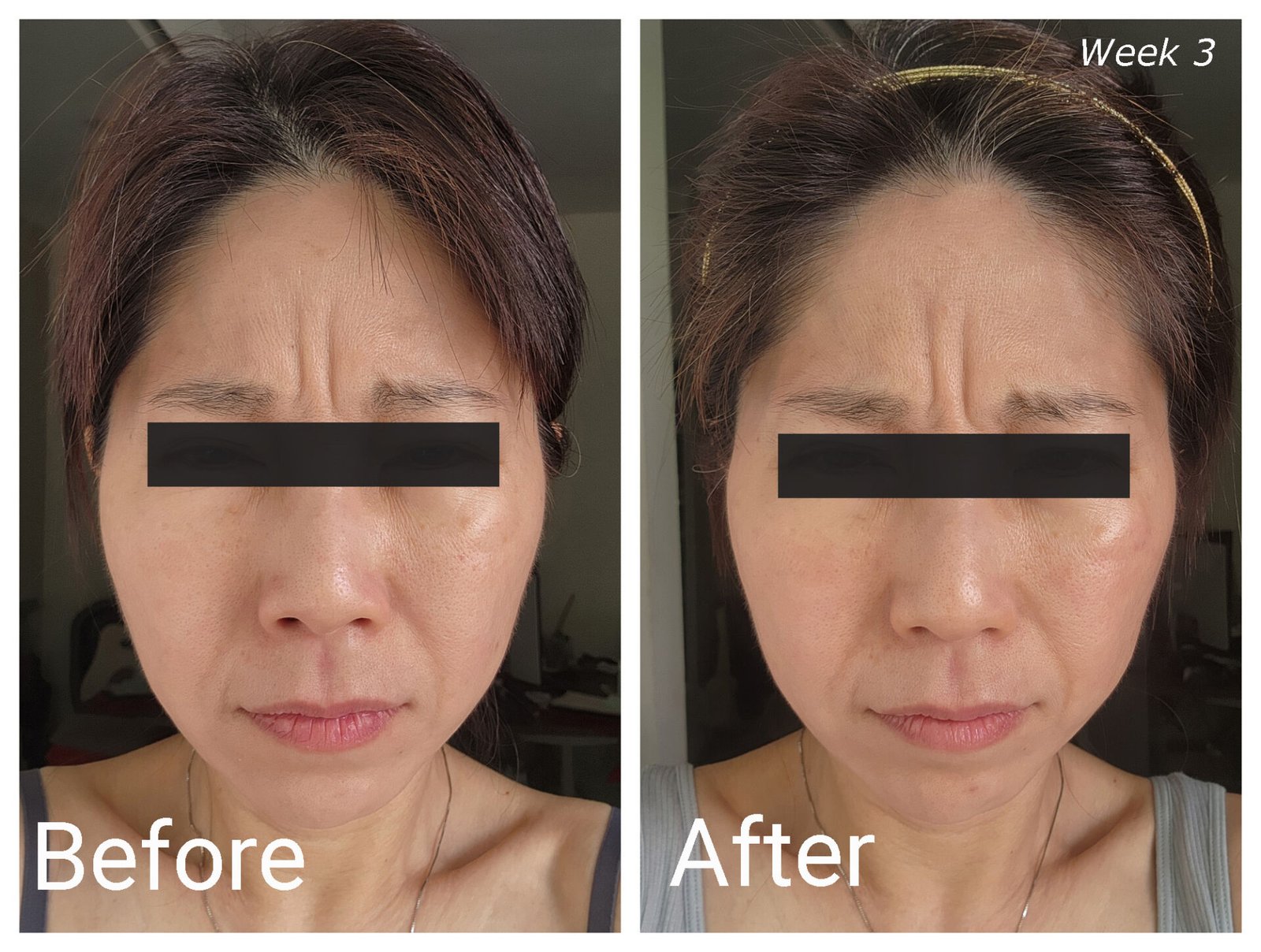 ZIIP HALO Before-After Week 3 (Frown)