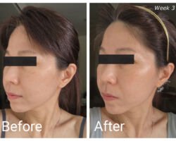 ZIIP HALO Before-After Week 3 (Left)