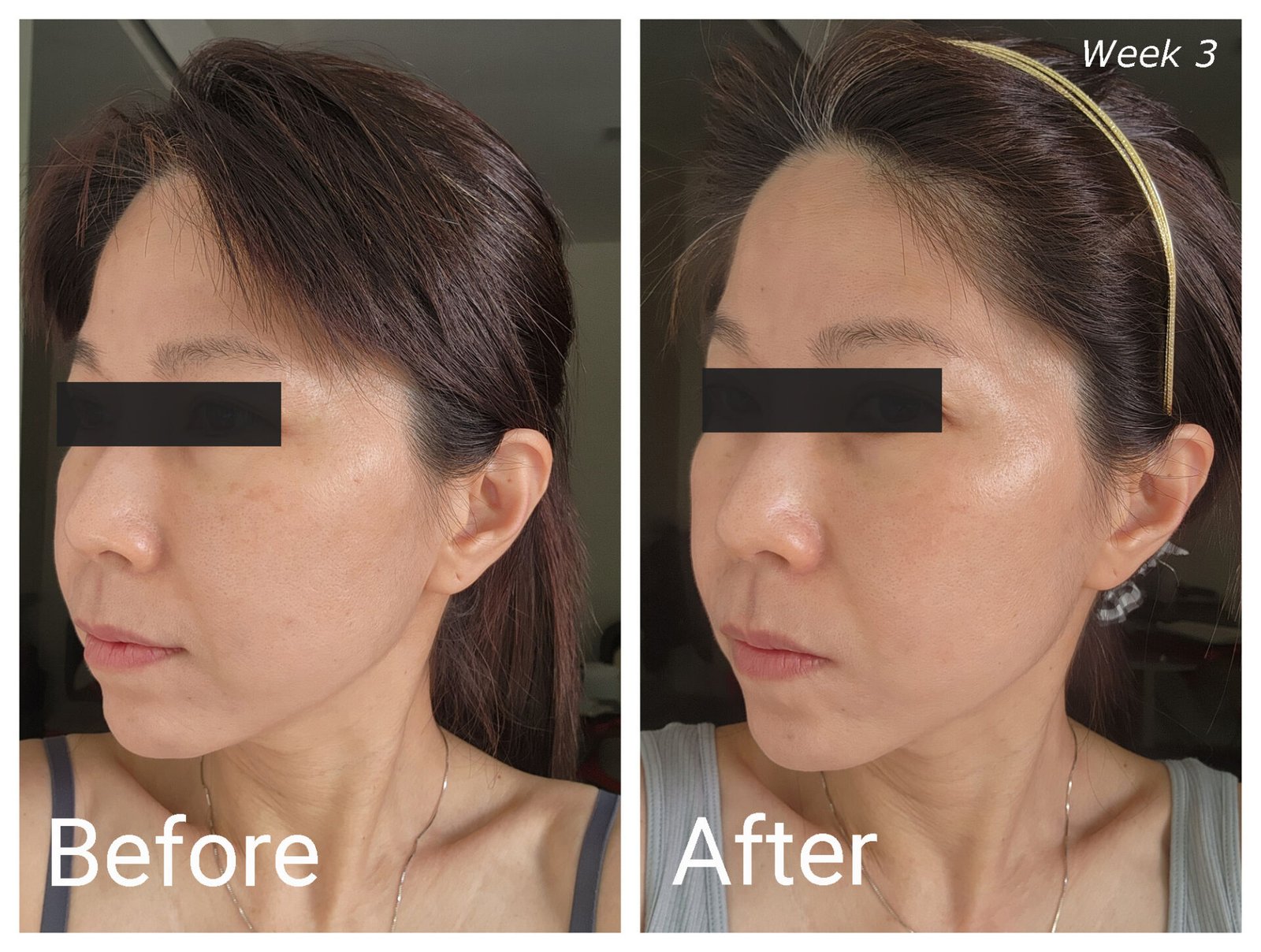 ZIIP HALO Before-After Week 3 (Left)