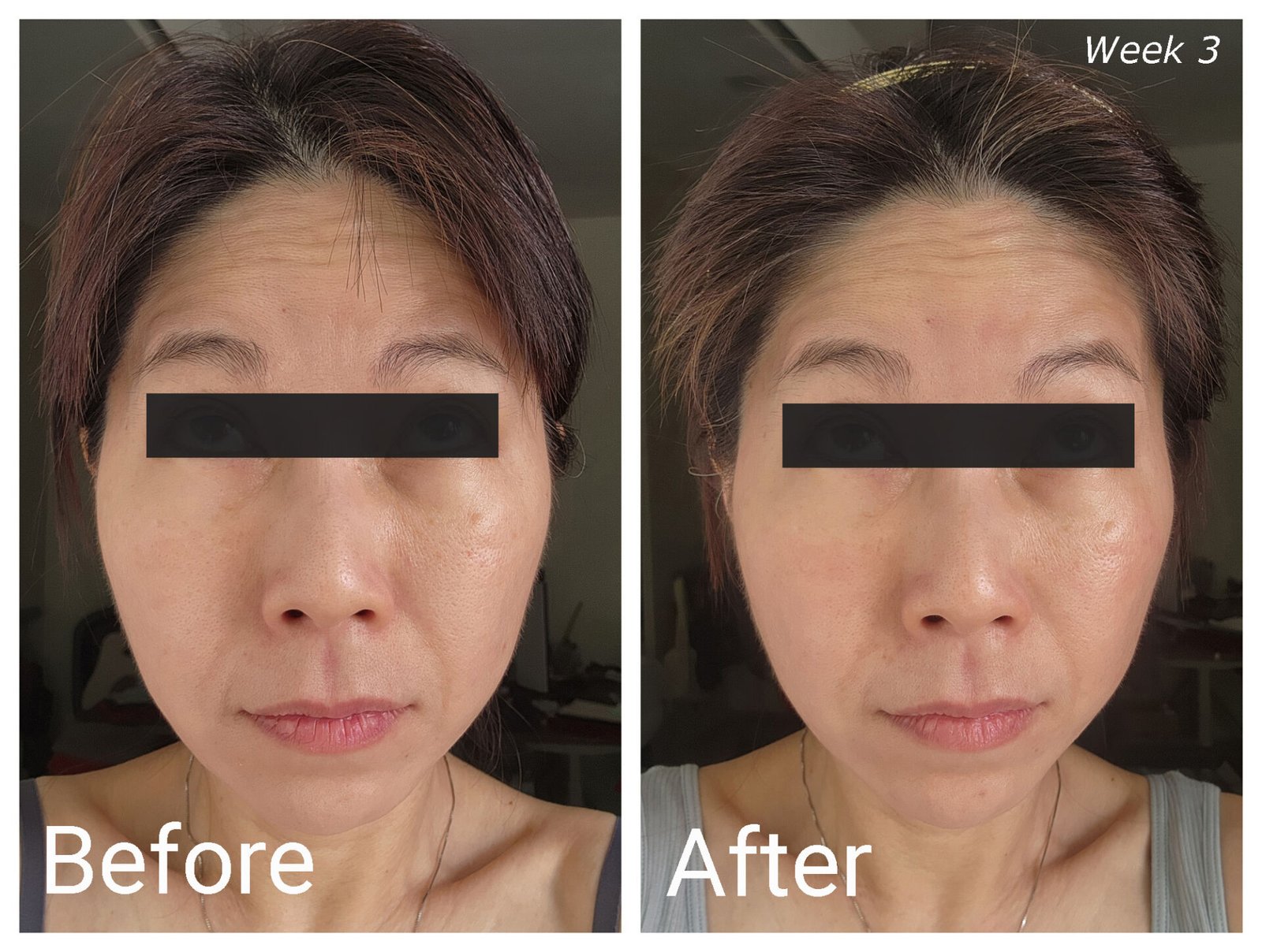 ZIIP HALO Before-After Week 3 (Look up)