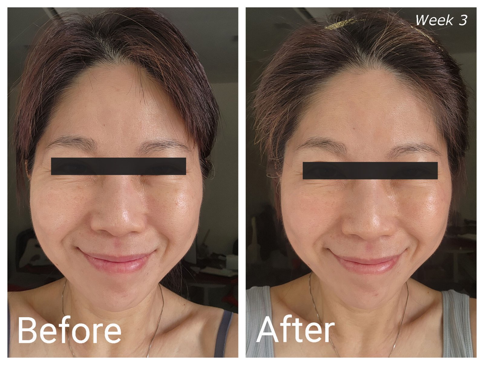 ZIIP HALO Before-After Week 3 (Smile)